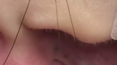 囤仔 - 黑頭粉刺來了 More Ear Blackheads!  - 澄熒SPA
