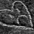 K0i - Atychiphobia