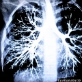 Bronchitis